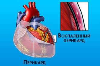 Методы диагностики избыточной жидкости в перикарде