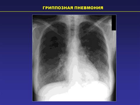 Методы диагностики очаговых инфильтративных изменений в легких