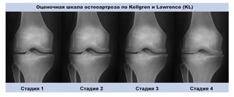 Методы диагностики суставной сумки коленного сустава