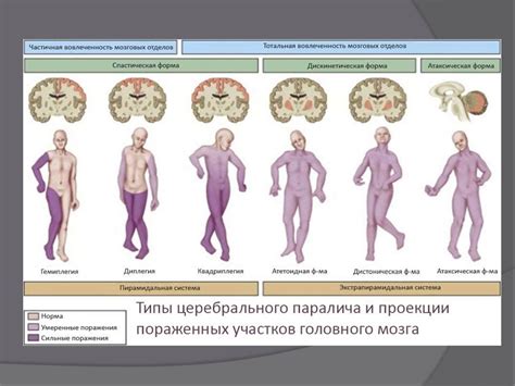 Методы лечения атактического церебрального паралича