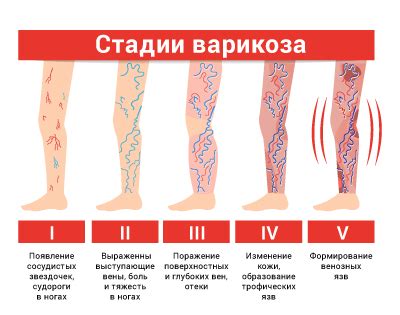 Методы лечения дилатации вен