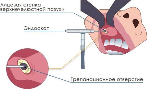 Методы лечения жидкости в верхнечелюстной пазухе