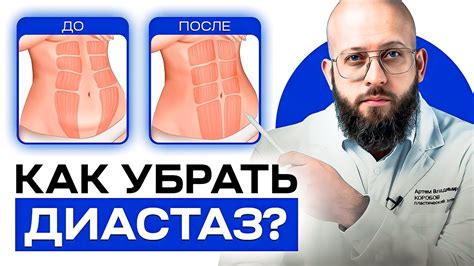 Методы лечения и профилактики диастаза