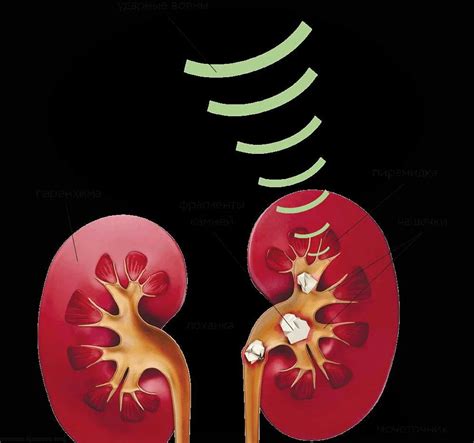 Методы лечения камней в почках