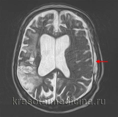 Методы лечения лейкопатии головного мозга у ребенка