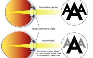 Методы лечения миопии 1 степени