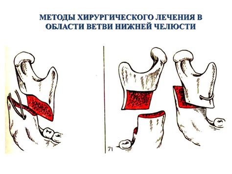 Методы лечения очаговой гиперфиксации в лицевом скелете