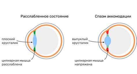 Методы лечения спазма аккомодации глаз