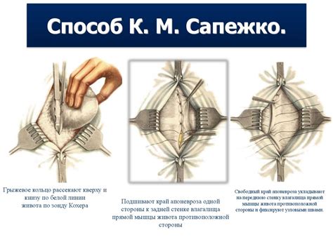 Методы лечения субсерозного узла по передней стенке