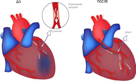 Методы проведения аортокоронарного шунтирования