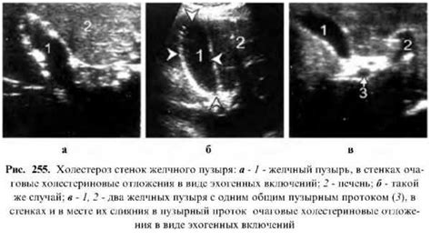 Методы эффективного лечения утолщения стенок мочевого пузыря