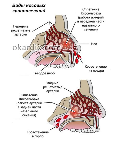 Механизм возникновения крови из носа