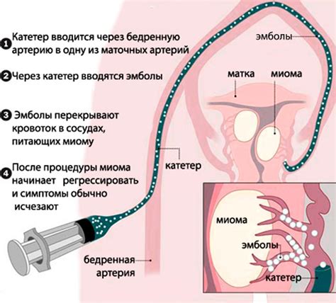 Миомэктомия и фертильность