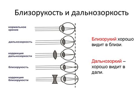 Миопия: определение и классификация