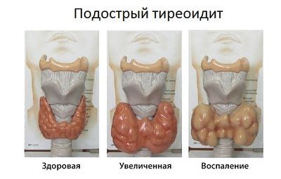 Может ли отрицательный АТ-ТПО исключить наличие щитовидной патологии