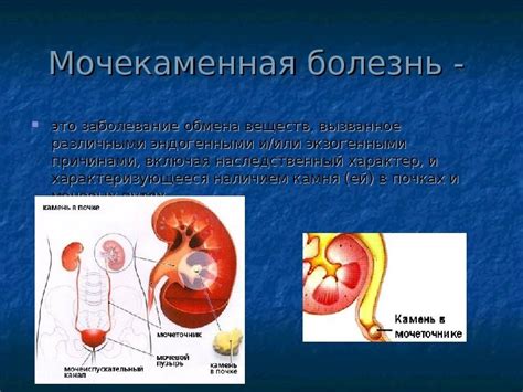 Мочекаменная болезнь: причины и лечение