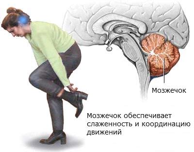 Нарушение координации