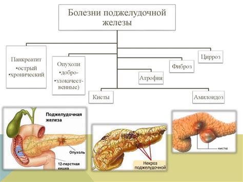 Нарушение работы поджелудочной железы и гормональный дисбаланс