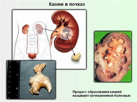 Негативный камень в почке