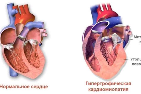 Недостаточность миокарда и митрального клапана 1 степени