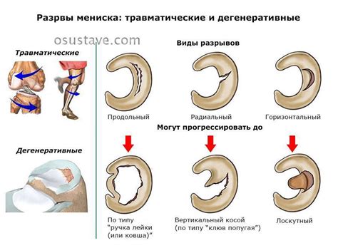 Некириргические методы лечения порванного мениска