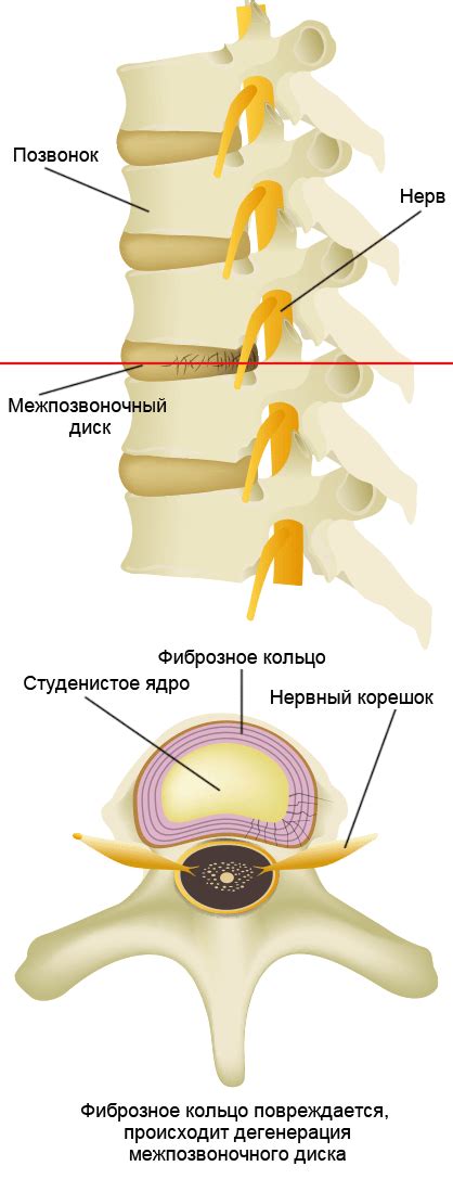 Несоответствие межпозвоночных дисков