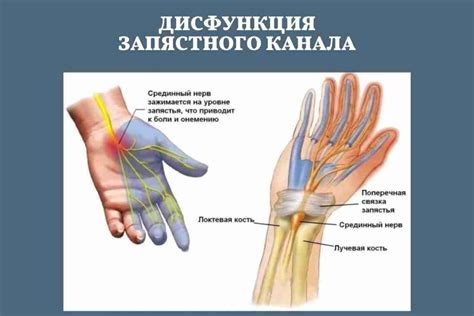 Не жди, узнай опасность: осложнения защемления нерва