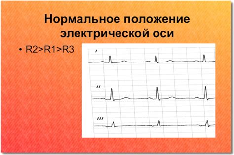 Нормальное положение синусового ритма