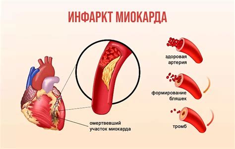 Обнаружение ишемической болезни сердца