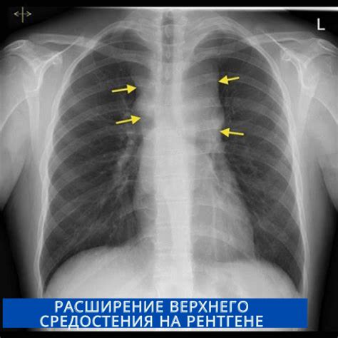 Обнаружение расширения верхнего средостения на рентгене