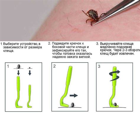 Обнаружение укуса клеща: