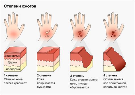 Ожоги и перегрев тканей