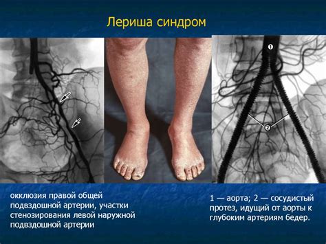 Окклюзионные заболевания сосудов конечностей