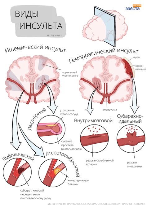 Онемение в результате ишемического инсульта