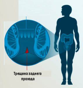 Опасности неправильного поведения при трещине заднего прохода