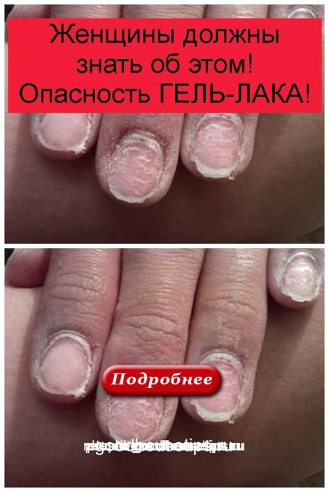 Опасность оставшегося гель лака на коже