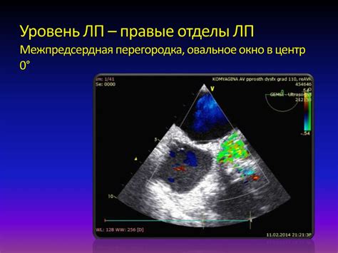 Описание открытого овального окна у ребенка