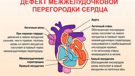 Определение и особенности дефекта межжелудочковой перегородки