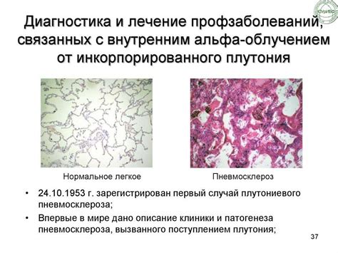 Определение и сущность диффузного пневмосклероза