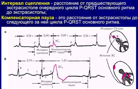 Определение нижнего предсердного ритма на ЭКГ