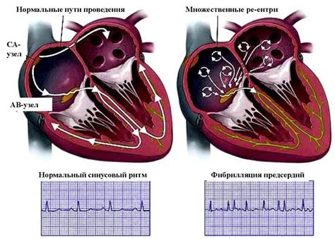 Определение фибрилляции предсердий