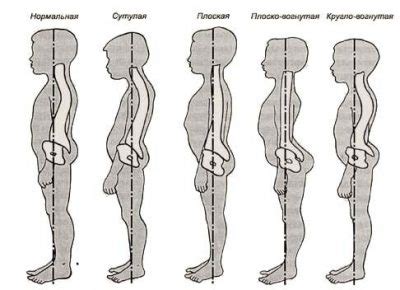 Осанка и ее связь с мышечной слабостью и болезнями