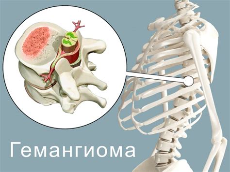 Осложнения и последствия гемангиомы TH12 позвонка