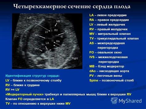 Осложнения при ложных хордах в левом желудочке: