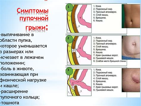 Основные правила после операции пупочной грыжи