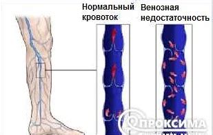 Основные признаки и симптомы венозного застоя в МКК