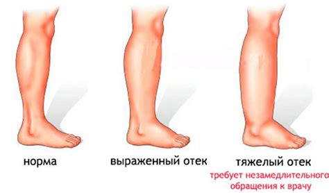 Основные признаки и симптомы опухших ног