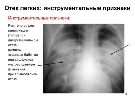 Основные признаки отростков на легком