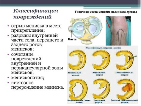 Основные признаки повреждения мениска