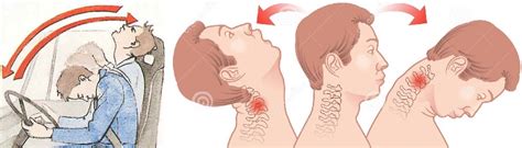 Основные признаки хлыстовой травмы шейного отдела